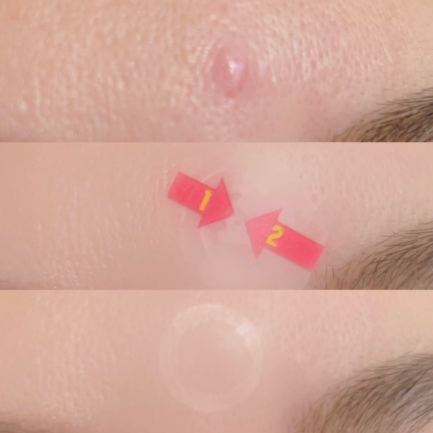 キャッチミーパッチ/CATCH ME PATCH/にきびパッチを使ったクチコミ(5枚目)