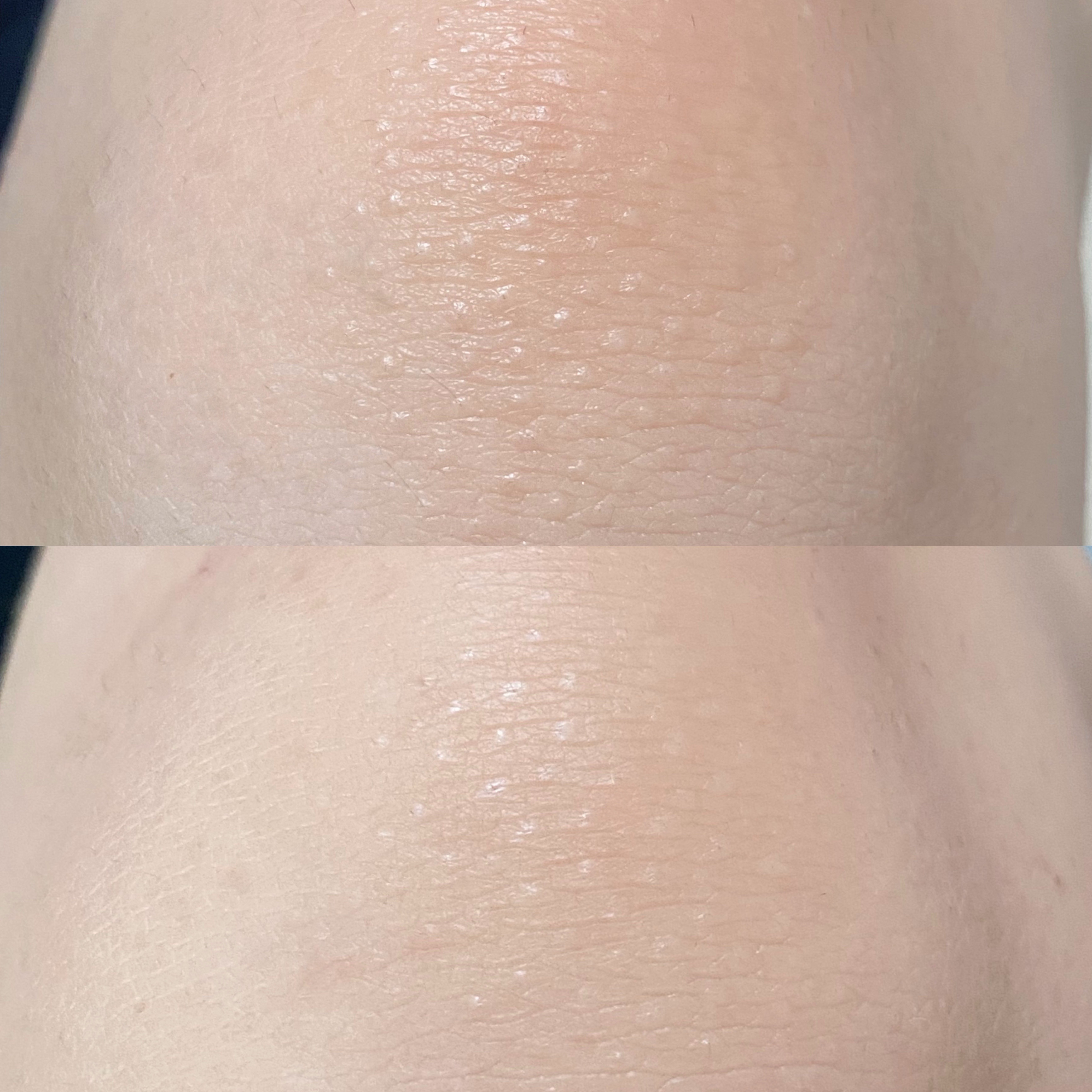 U20クリーム(医薬品)/メンターム/その他を使ったクチコミ（3枚目）