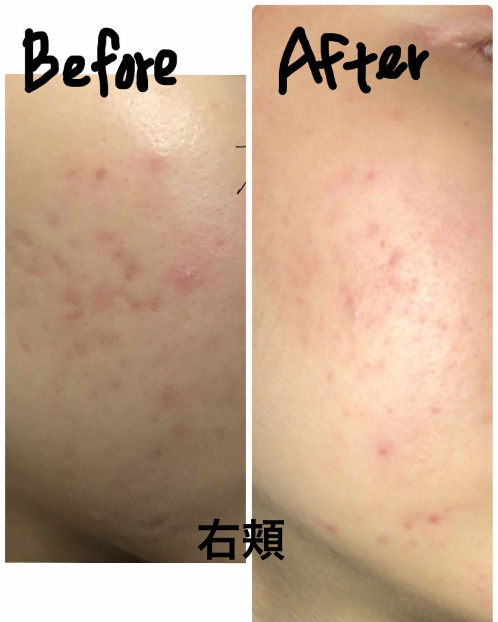 最近は無駄遣い女 on LIPS 「写真は前の投稿と同じ並び。現在、現在、過去。右頬は色素沈着のニ..」(3枚目)