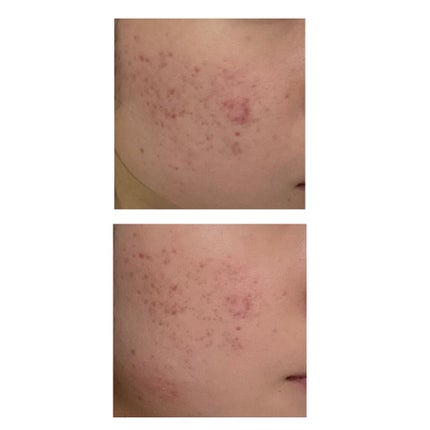 ベピオゲル/マルホ株式会社/その他を使ったクチコミ(2枚目)