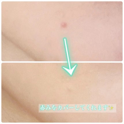 薬用スポットシーラークリーム/スキンヒーロー/クリームコンシーラーを使ったクチコミ(4枚目)