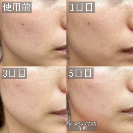 リードルショット100/VT/美容液を使ったクチコミ(9枚目)