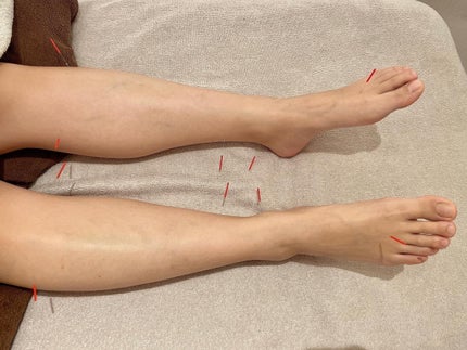 こままりえ@投稿ある方フォロバ✨ on LIPS 「初めての細胞美容鍼💓表参道駅から徒歩5分という好立地にある完全..」(6枚目)