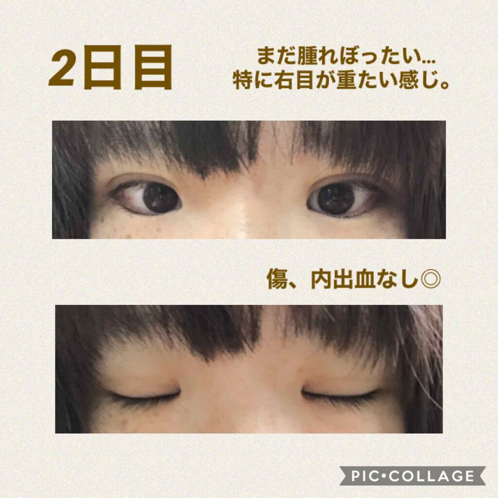 ぬこた on LIPS 「埋没2日目。まだ幅の広い二重な感じですが昨日よりは目のつっぱり..」(2枚目)