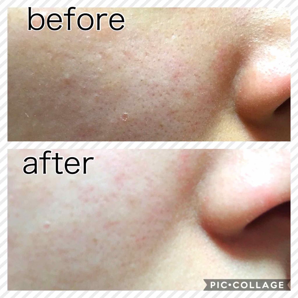 スーパー毛穴引き締めマスク プラセンタ/ラボラボ/シートマスク・パックを使ったクチコミ(3枚目)