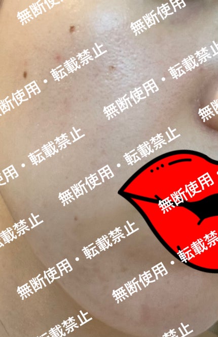 VC ホワイトピールセラム/SKIO/ブースター・導入液を使ったクチコミ(6枚目)