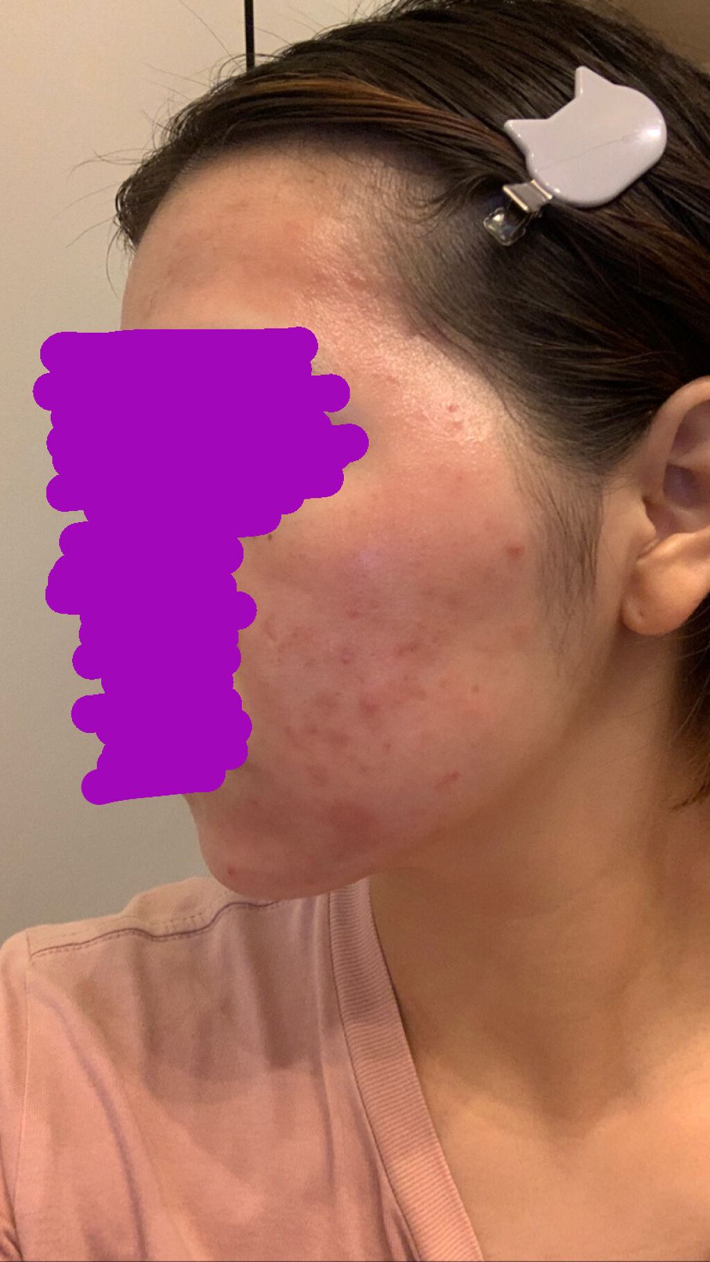 あずさ on LIPS 「エピデュオゲル7日目!かなり赤みが全体に出て乾燥しています塗っ..」(2枚目)