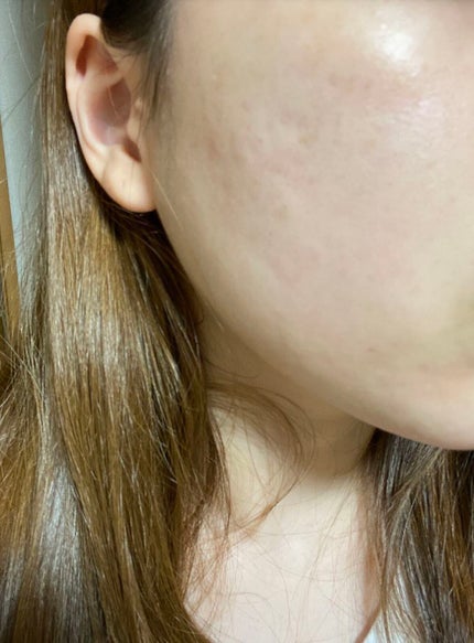 ナチュラボ 生ハーブピーリング/石澤研究所/ピーリングを使ったクチコミ(1枚目)