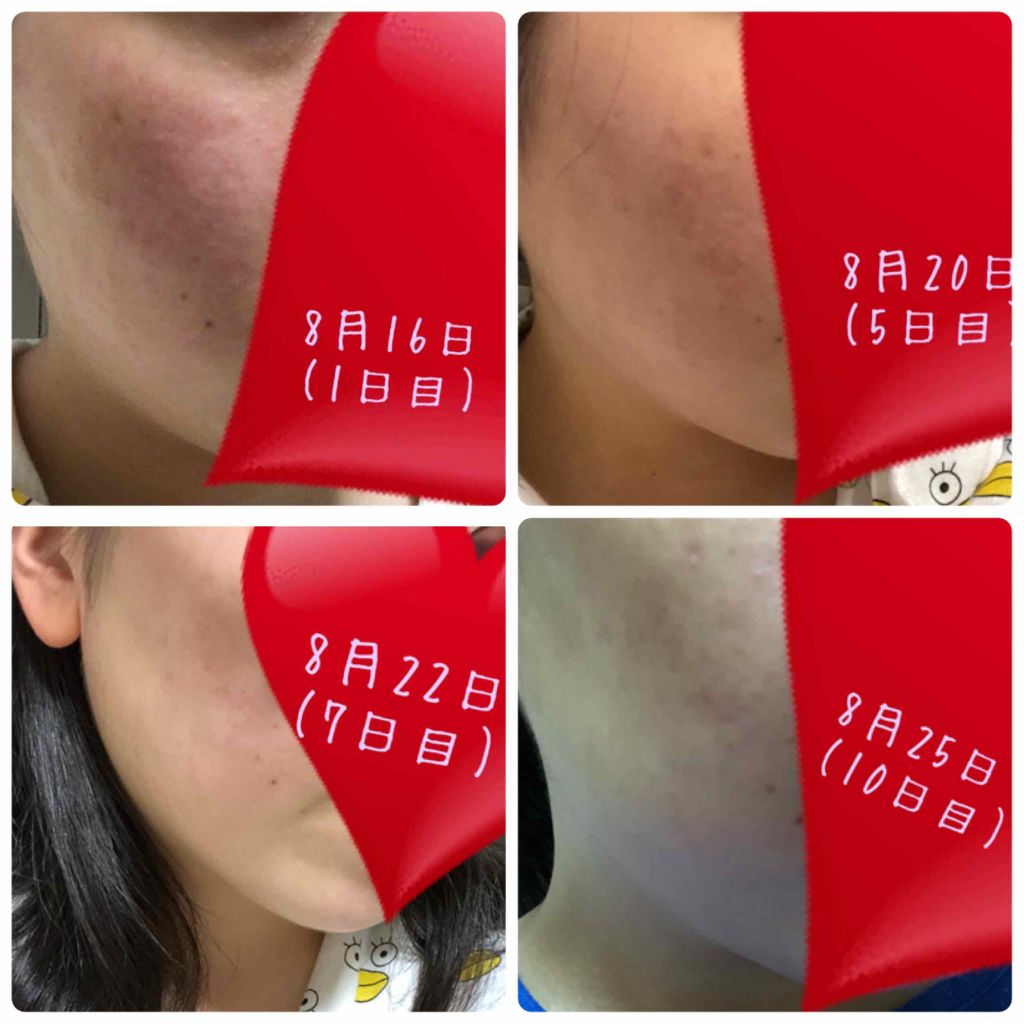 薬用 しみ 集中対策 美容液/メラノCC/美容液を使ったクチコミ（2枚目）