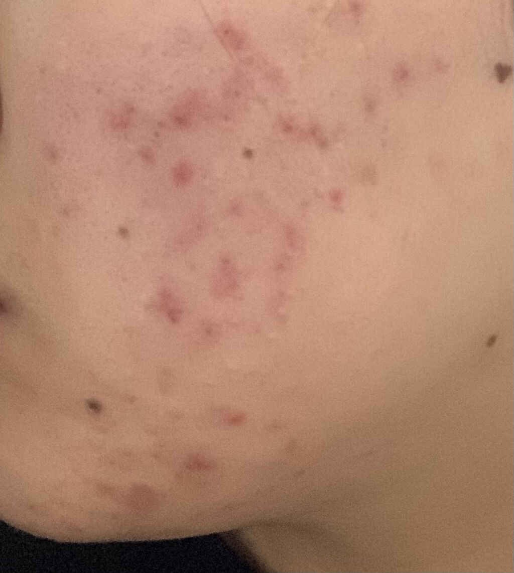 クリンダマイシンゲル(医薬品)/クラシエ薬品/その他を使ったクチコミ（1枚目）