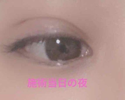 asir on LIPS 「二重整形 埋没(2点留め)10/3整形しました!⚠️写真注意で..」(2枚目)