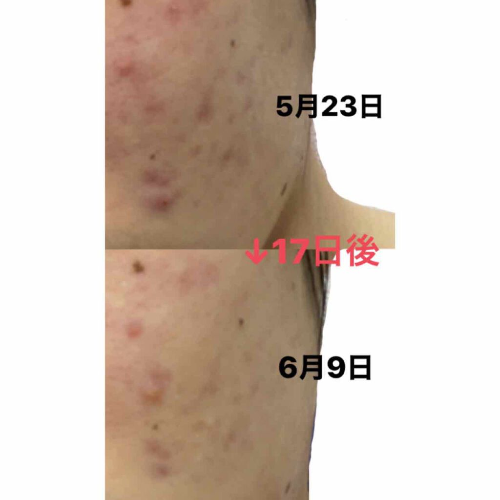 ハトムギ化粧水(ナチュリエ スキンコンディショナー R )/ナチュリエ/化粧水を使ったクチコミ（1枚目）