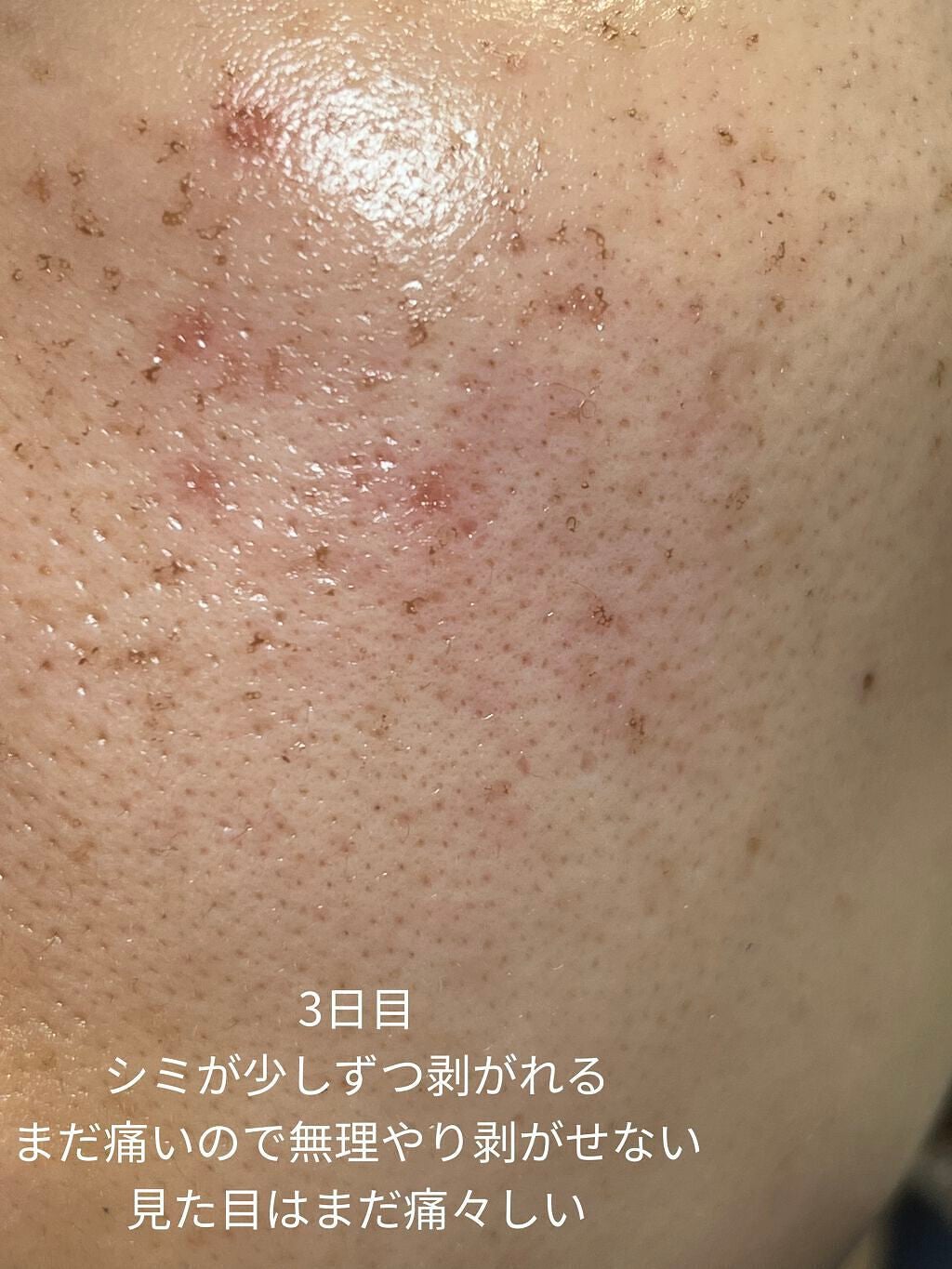 侘助 on LIPS 「【美容医療でシミ取り記録】こんにちは、侘助です❁❁❁今回は美容..」(4枚目)