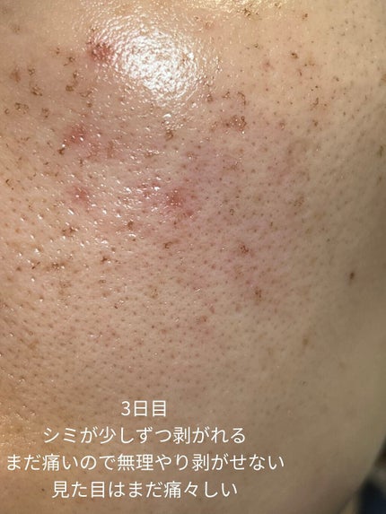 侘助 on LIPS 「【美容医療でシミ取り記録】こんにちは、侘助です❁❁❁今回は美容..」(4枚目)