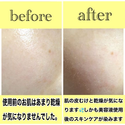 ビタペアC 集中美容液スペシャルセット/ネイチャーリパブリック/美容液を使ったクチコミ(4枚目)