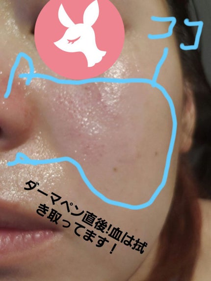 ダーマペン・ダーマスタンプ/MyM/その他スキンケアグッズを使ったクチコミ(5枚目)