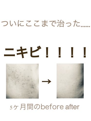 A’pieu マデカソ CICA化粧水のクチコミ「こんにちは☀️

久しぶりのニキビ投稿となります！
この五ヶ月間…だんだん成果が見えてきました.....」（1枚目）