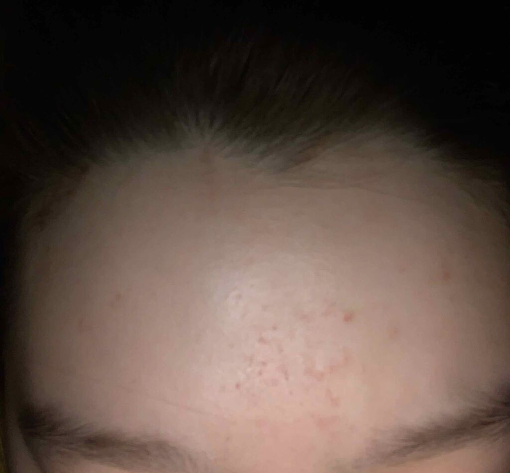 トレリアン モイスチャー ローション/ラ ロッシュ ポゼ/化粧水を使ったクチコミ（3枚目）