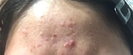 fresh_make_63hp on LIPS 「お肌日記👩🏻✊🏻3週間前と今:日に日にひどくなるのはなんでなの..」(4枚目)