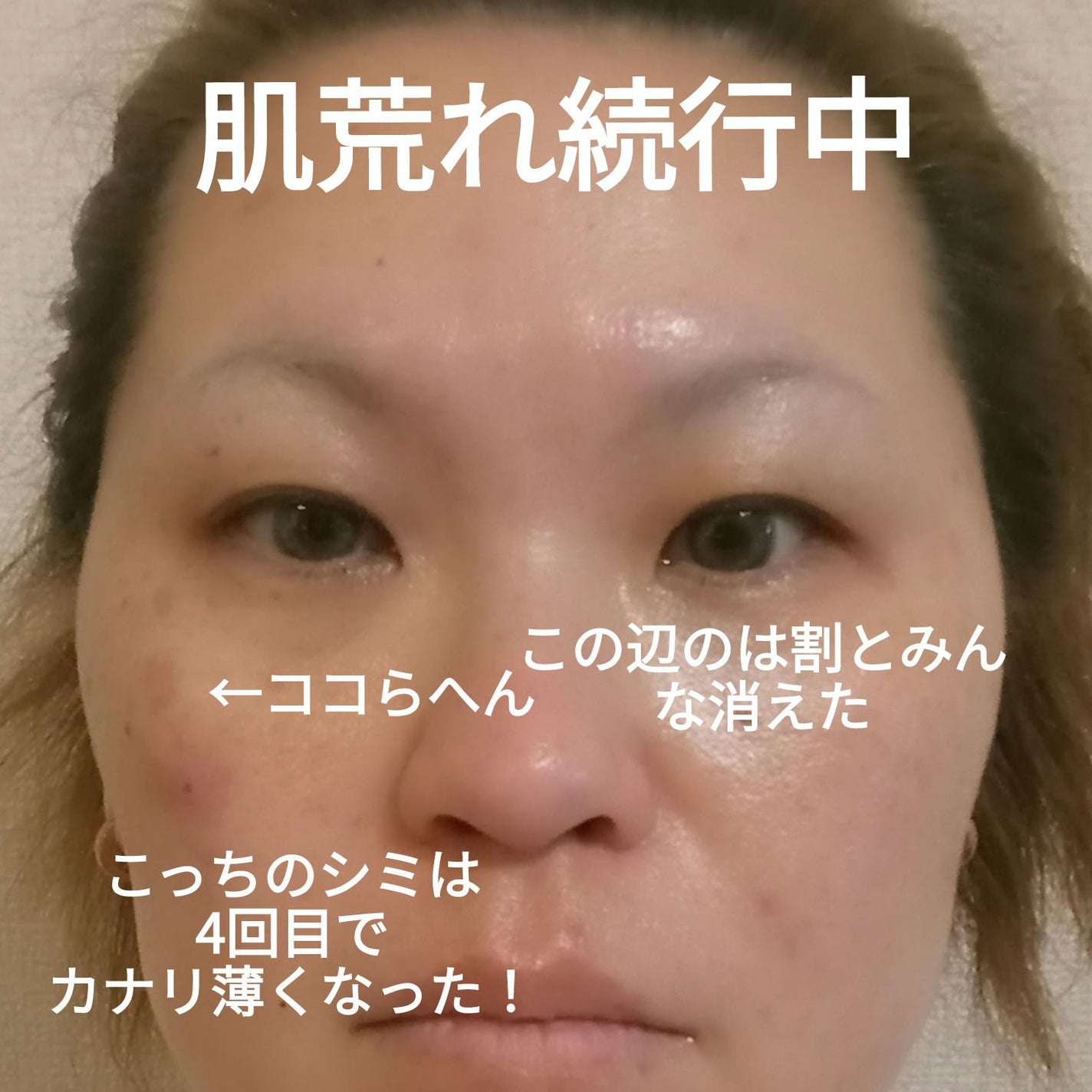 ビヨンセ奥二重向上委員長🥸LIPSパートナー🥳 on LIPS 「湘南美容IPL治療 フォトダブル4回目の1週間経過後の写真です..」(3枚目)