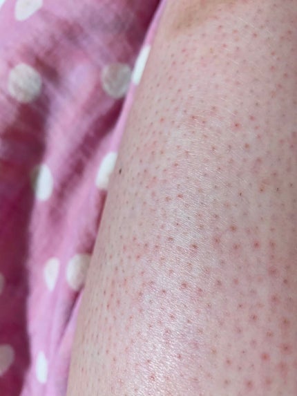 らいとんと@一重 on LIPS 「医療脱毛体験記〜Part1〜❥❥❥❥❥❥❥❥❥❥❥❥❥❥❥❥❥..」(8枚目)