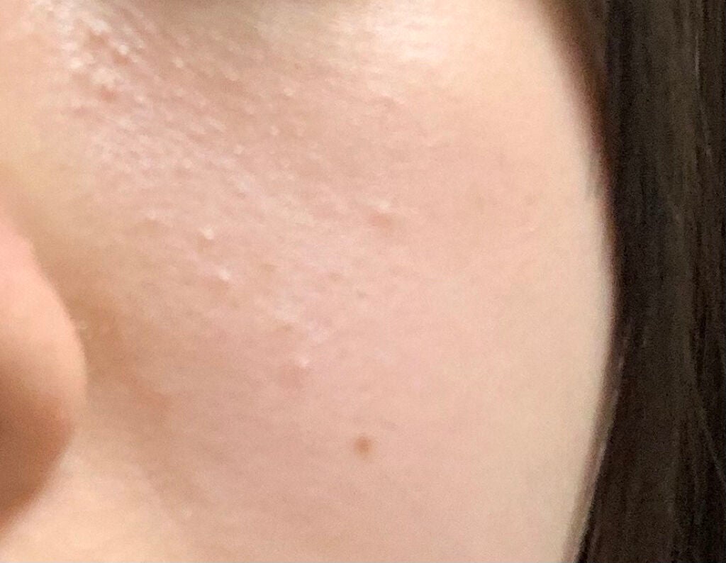 み な on LIPS 「こんにちは!みなです!2枚の写真のように鼻の横目の下あたりにニ..」(2枚目)