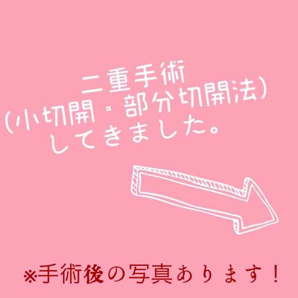 fantastic_blush_7x5 on LIPS 「本日、二重手術(小切開法・部分切開法)をしてきました。場所は兵..」(1枚目)