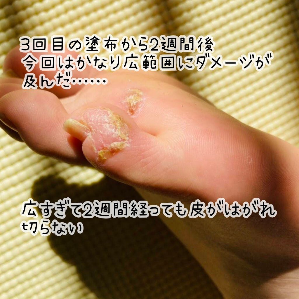 敏感肌な研究者💊あすか💊 on LIPS 「⚠️グロ注意⚠️ #イボ取り日記強酸による薬品治療、痛かったぁ..」(7枚目)