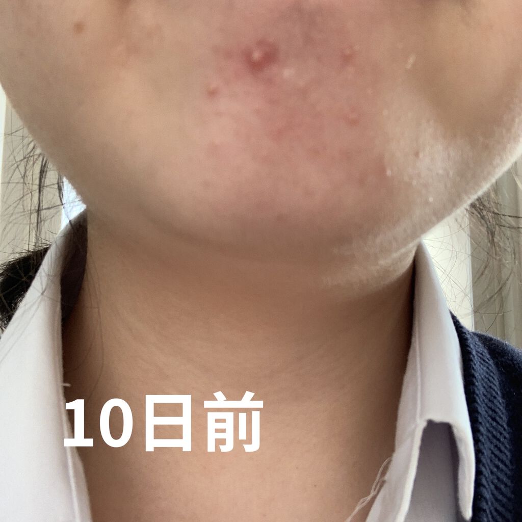 薬用 しみ 集中対策 美容液/メラノCC/美容液を使ったクチコミ（1枚目）