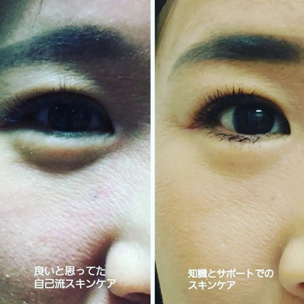 美肌カウンセラー💆肌悩みを解決し見る世界を変える on LIPS 「【アトピー改善🧙♂️終着点はどこ?】アトピーの辛さ・苦しみか..」(4枚目)