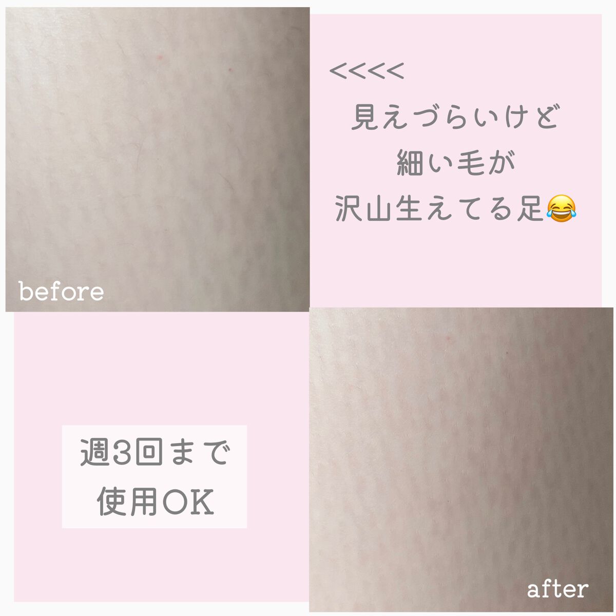 コードレス脱毛器/Noend/家庭用脱毛器を使ったクチコミ(4枚目)
