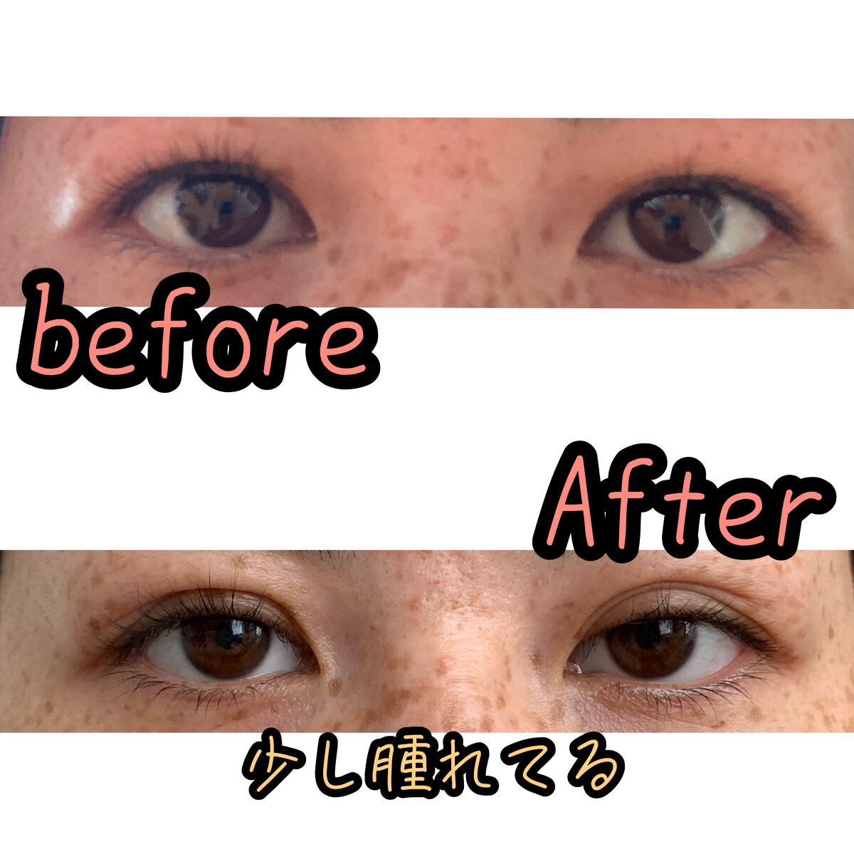 二重整形/その他を使ったクチコミ（2枚目）