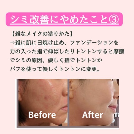 美肌カウンセラー💆肌悩みを解決し見る世界を変える on LIPS 「肌を綺麗にする専門家💆肌荒れ難民族だったわたしが"シミ改善のた..」(5枚目)