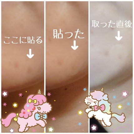 プロCICA クリアスポットパッチ/VT/その他スキンケアを使ったクチコミ(3枚目)