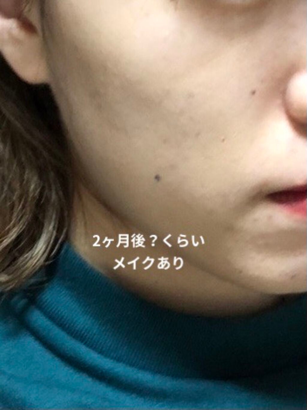 薬用 アクネケア コンシーラー/DHC/クリームコンシーラーを使ったクチコミ(3枚目)