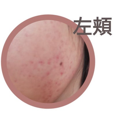 薬用クリーム洗顔/メンソレータム アクネス/洗顔フォームを使ったクチコミ(3枚目)