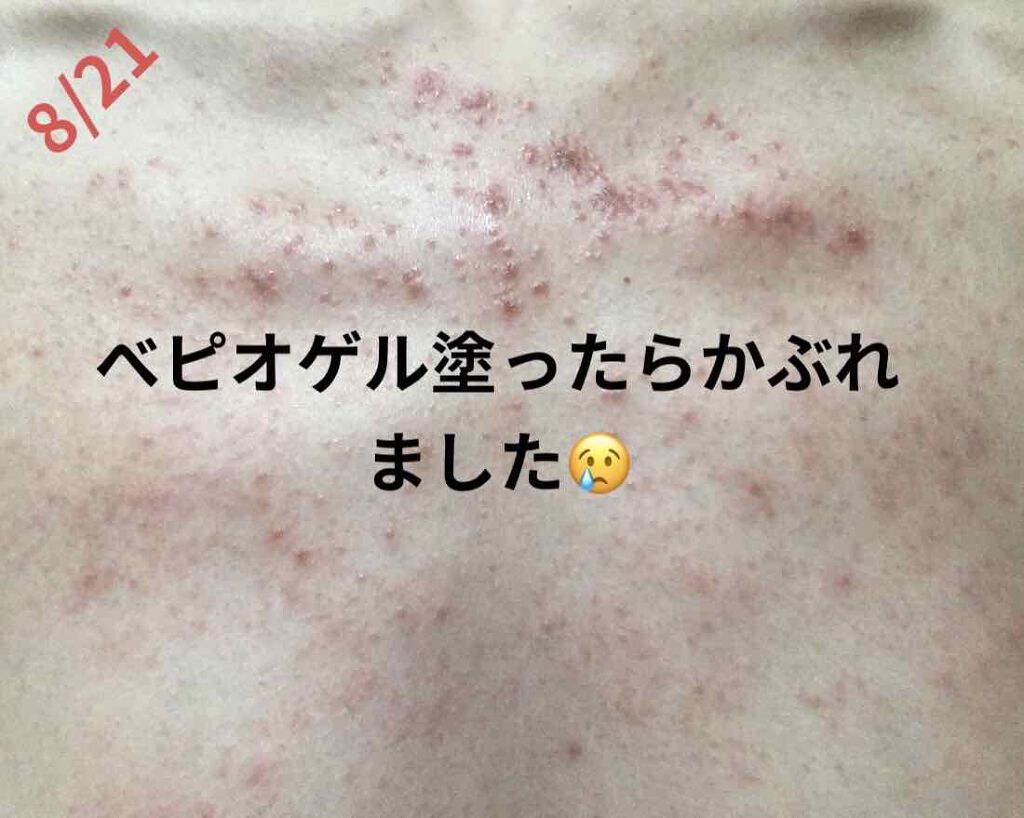 オロナインH軟膏 (医薬品)/オロナイン/その他を使ったクチコミ(2枚目)