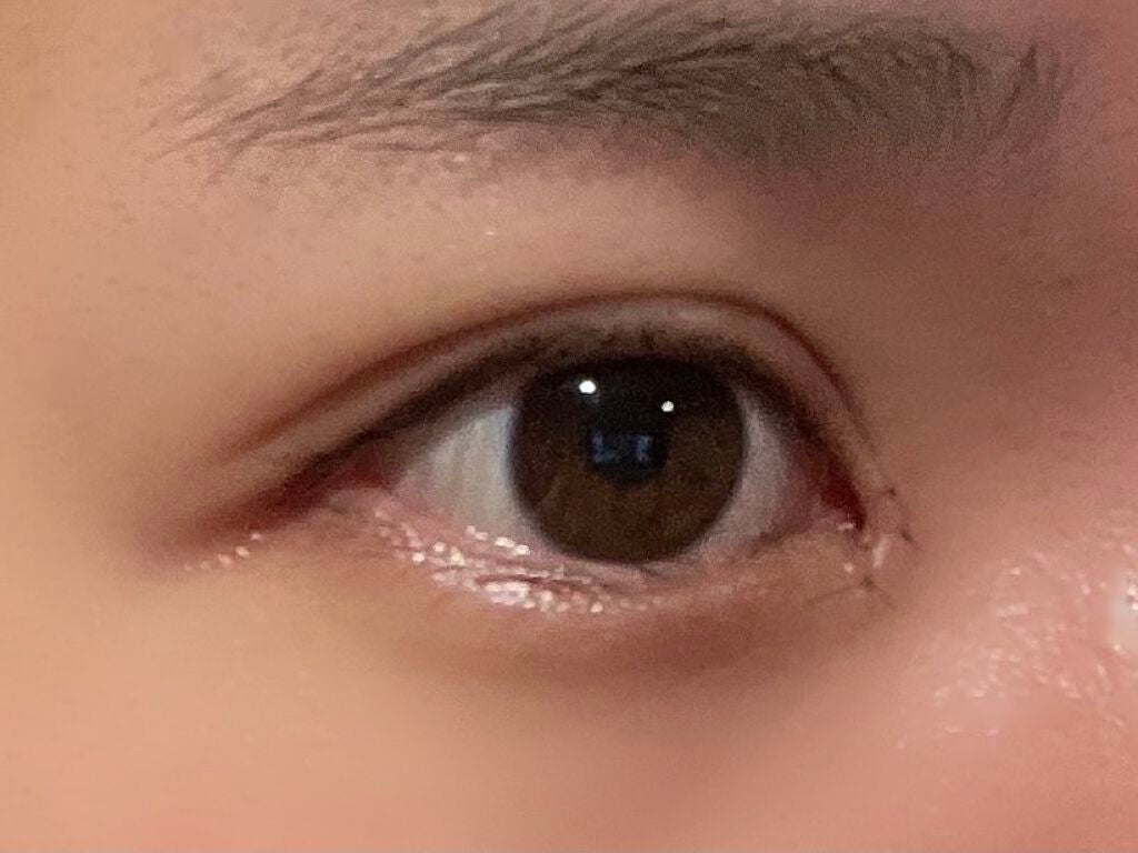 さくら。 on LIPS 「埋没法二回目、目頭切開。6日目夜。一枚目アイメイク有り。目頭は..」(2枚目)