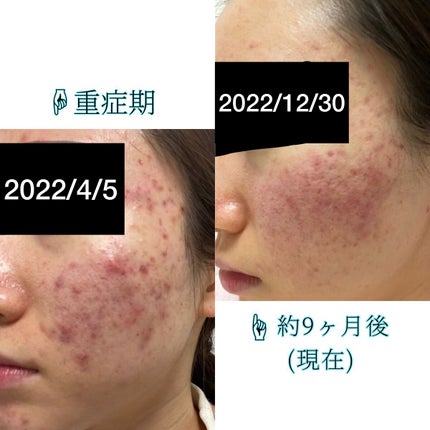 潤浸保湿 化粧水 III とてもしっとり/キュレル/化粧水を使ったクチコミ(2枚目)