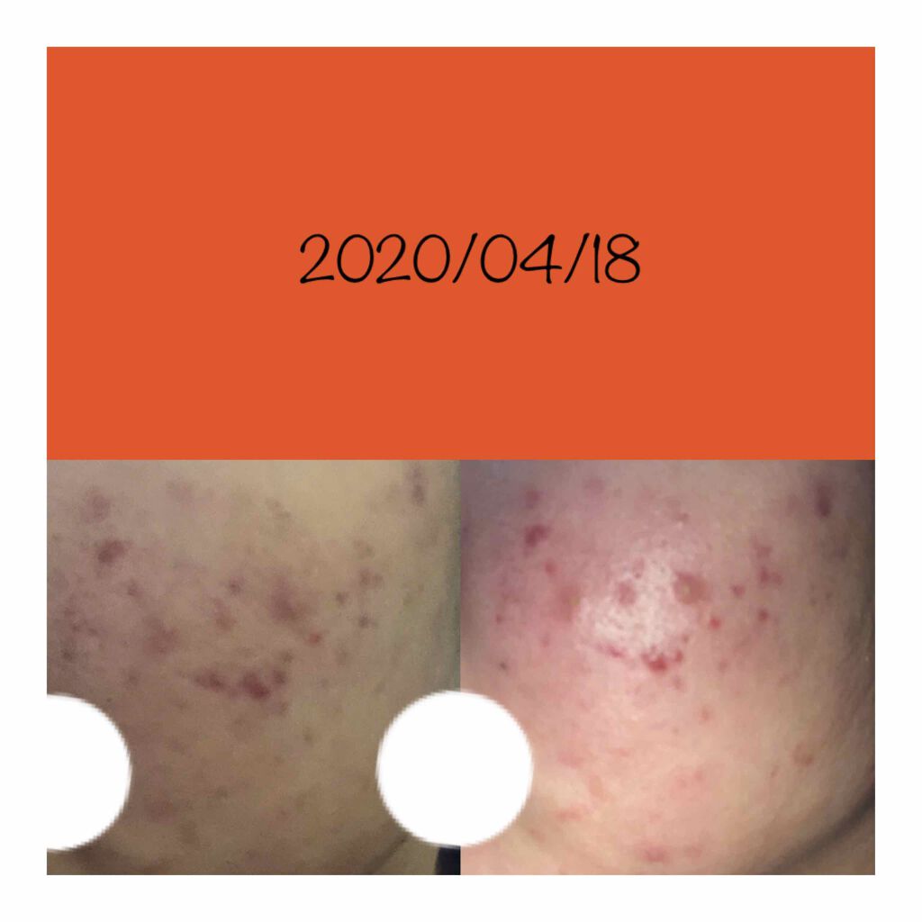 ビーソフテン ローション(医薬品)/持田製薬/その他を使ったクチコミ（2枚目）