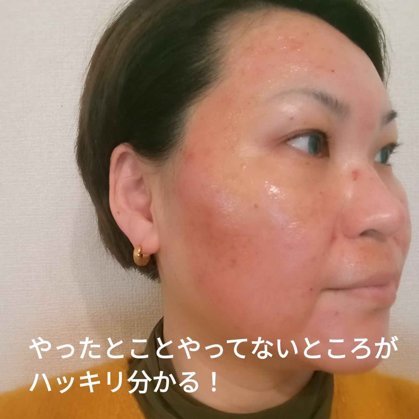 ビヨンセ奥二重向上委員長🥸LIPSパートナー🥳 on LIPS 「ダーマペン4をやってきたよ!!何種類か選べる薬剤から私はボトッ..」(8枚目)