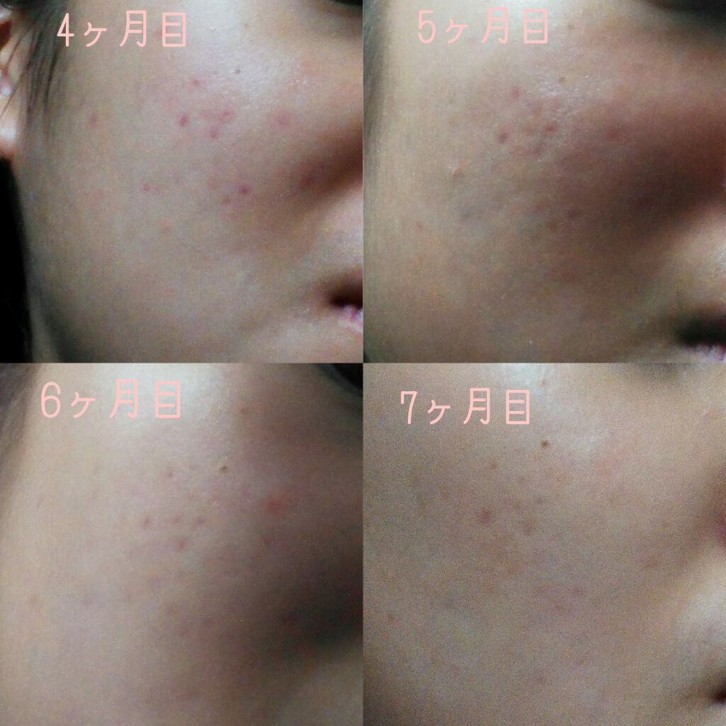 ペアアクネクリームW(医薬品)/ペア/その他を使ったクチコミ（3枚目）