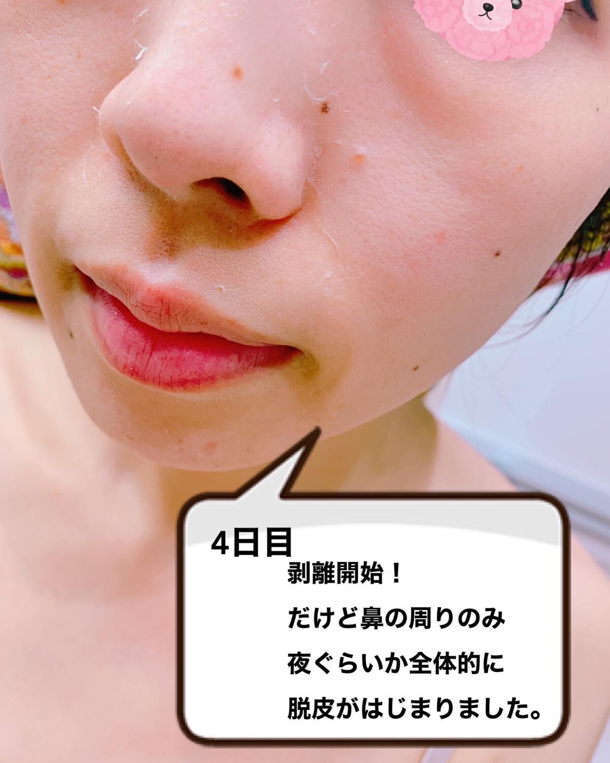 ダーマスキンピーリング/BQCELL/その他キットセットを使ったクチコミ(5枚目)