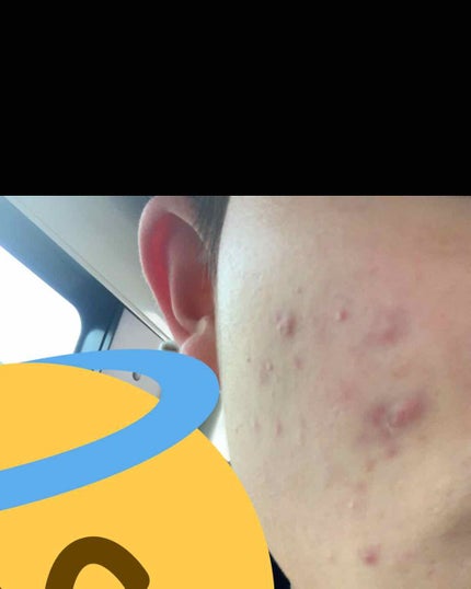 テラ・コートリル 軟膏(医薬品)/ジョンソン・エンド・ジョンソン/その他を使ったクチコミ(1枚目)