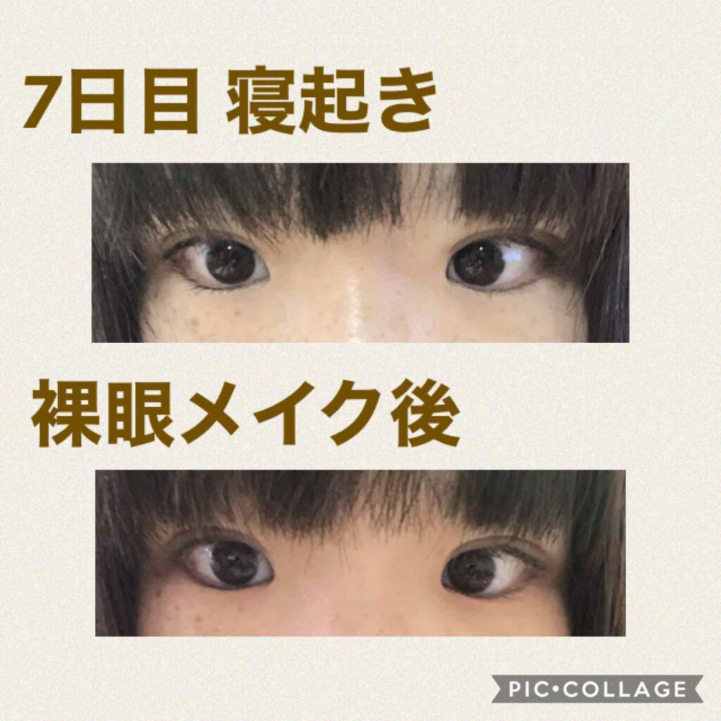 ぬこた on LIPS 「ダウンタイムといわれる1週間終わりました!3枚目にまとめ画像貼..」(2枚目)