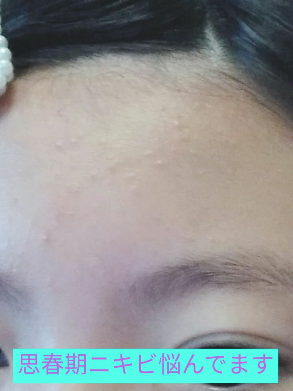 アポスティーローション(医薬品)/アポスティー/その他を使ったクチコミ(1枚目)