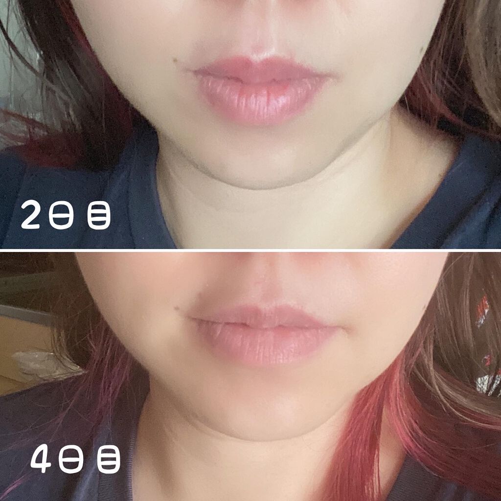 ちっちみ on LIPS 「。*♡……♡*。。*♡……♡*。1週間経ったので、ボトックスの..」(3枚目)