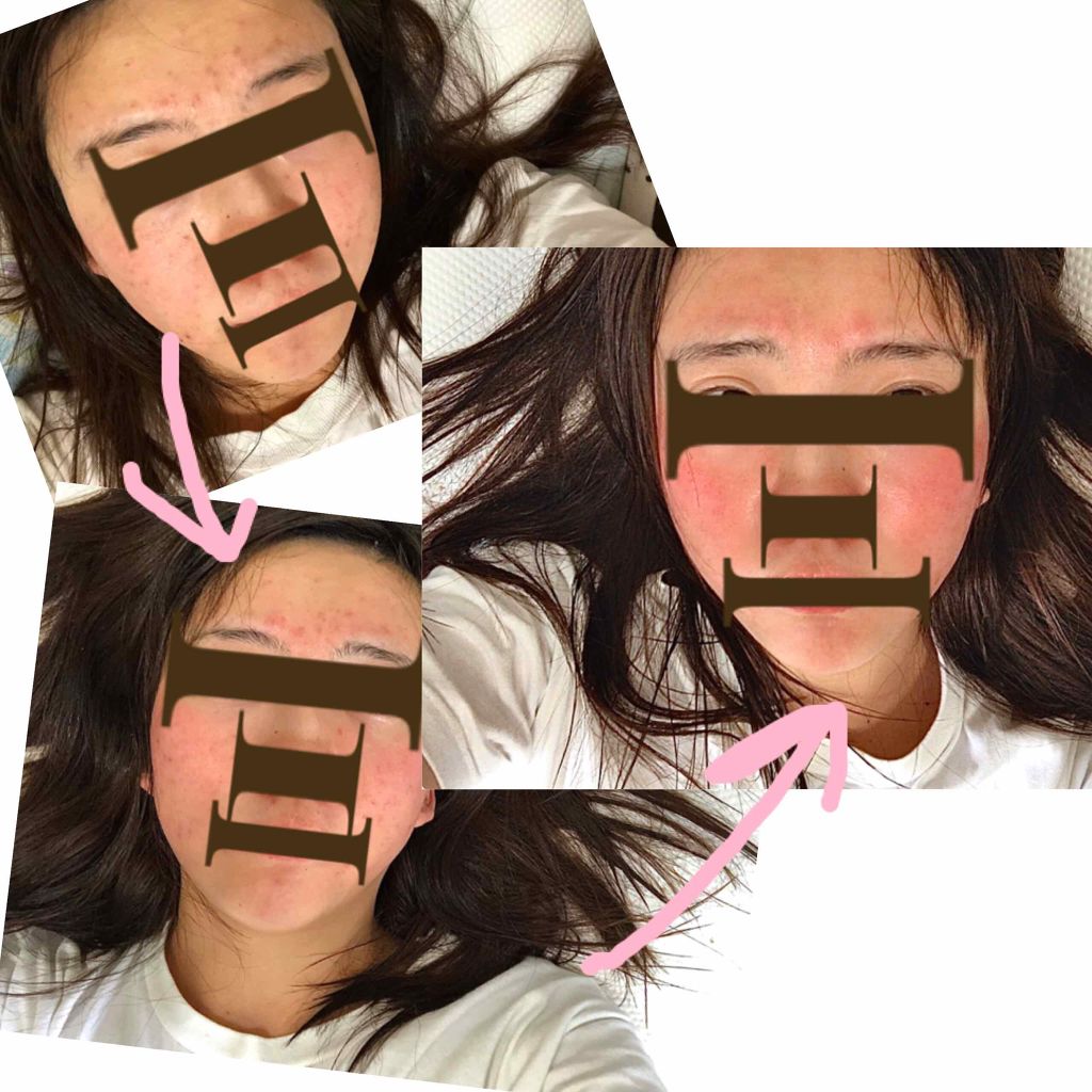 テラ・コートリル 軟膏(医薬品)/ジョンソン・エンド・ジョンソン/その他を使ったクチコミ(3枚目)