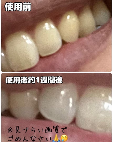 シャンティ on LIPS 「\歯科衛生士が選ぶ/ドラックストアでも購入可能な✨オススメ美白..」(4枚目)