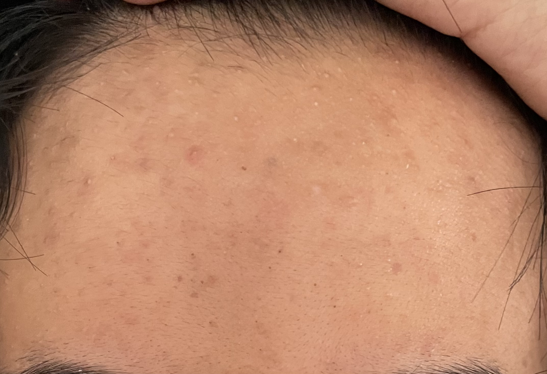 リフレッシング トナー（薬用化粧水）/プロアクティブ/化粧水を使ったクチコミ（1枚目）